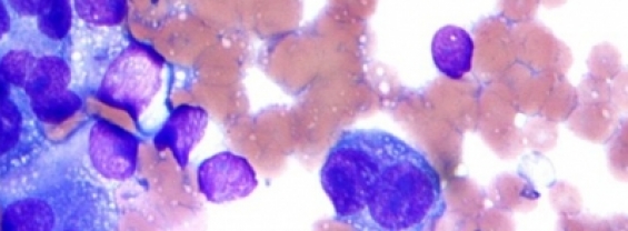 Melanoma: identificate le micro-molecole prodotte dai tumori